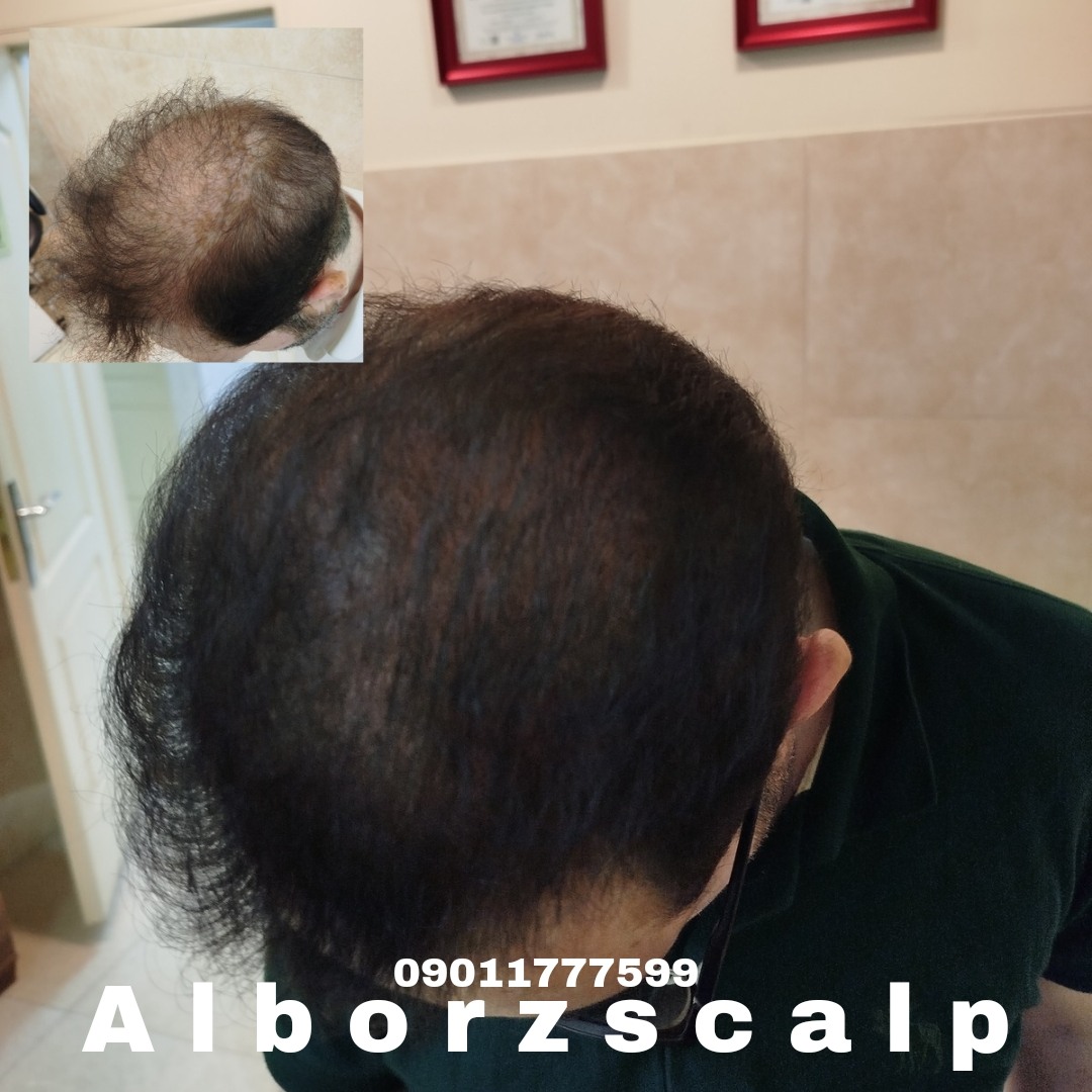 اسکالپ پوششی